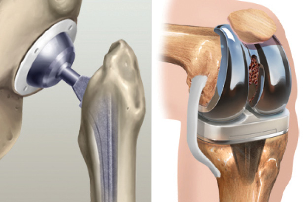 Hip and knee joint replacement illustrations