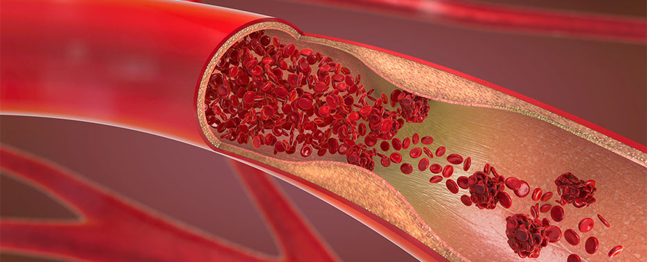 Illustration of arteriosclerosis