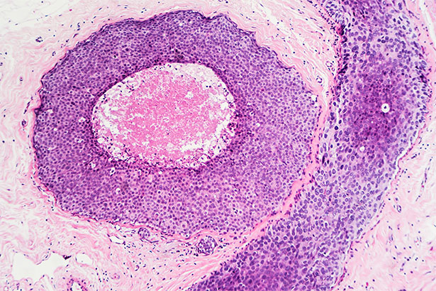 Breast cancer - ductal carcinoma in situ (DCIS)