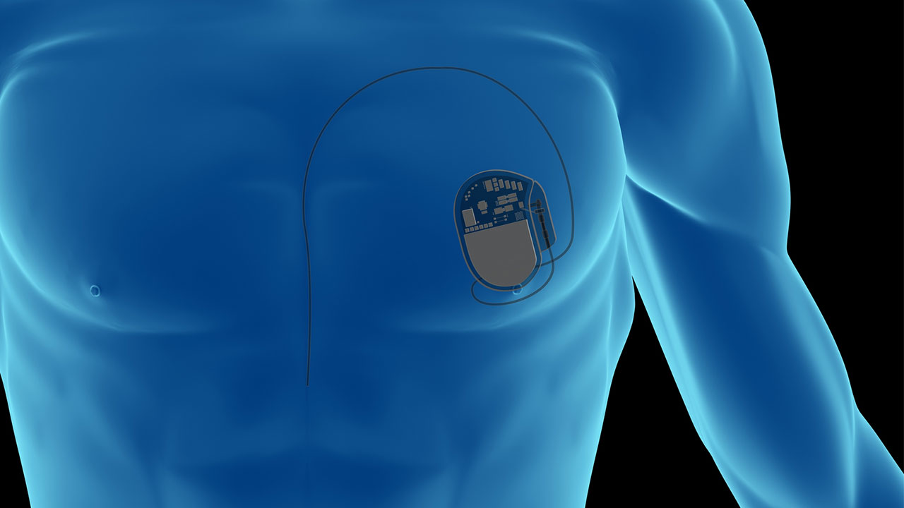 Illustration of x-ray showing pacemaker