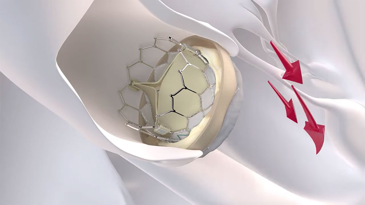 Animation: Transcatheter Aortic Valve Replacement (TAVR) - Transfemoral Approach