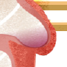 Illustration: Detail of the left atrial appendage (LAA)